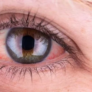 Uzrok crvenih očiju u metodama za odrasle i liječenje. Povrede i bolesti očiju
